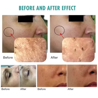 Appareil de soin du visage 3 en 1 à nano-bulles – image 3